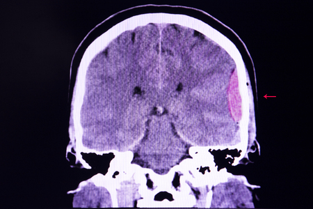 CT scan of the brain of a traffic accident patient showing large epidural hemorrhage on his left cerebral hemisphere with some degree of brain edemaの写真素材