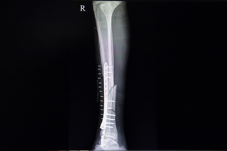 A leg x-ray film of a traumatic injuried patient with comminuted fracture of femural shalf  with metal plate and screws fixation.の写真素材