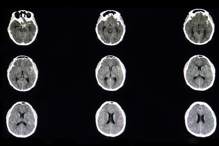 A CT brain scan of a patient with subarachnoid hemorrhage in left basal cistern from ruptured cerebral cavernous aneurysm.の写真素材