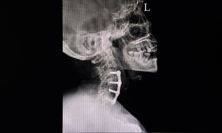 Xray film of a neck of a patient who had spinal surgery showing plate and screw fixations at C3-C5...