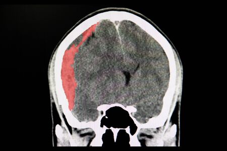 A CT scan of the brain of a patient with trafic accident showing acute subdural hematoma.の写真素材