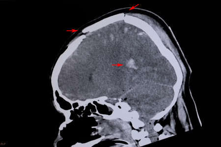 Xray film of a patient with skull fractues and intracerebral hemorrhages.