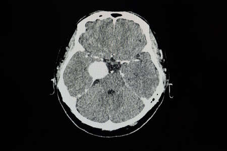 CT brain scan with contrast of a patient showing 3.8 cm rim enhancing lesion at right cavernous...