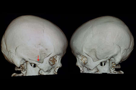 A 3D rendering scan of a skull of a patient with right zygomatic bone fractureの写真素材