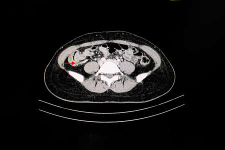 CT Scan of an abdomen of a patient with abdominal pain showing swollen appendix suggesting the...