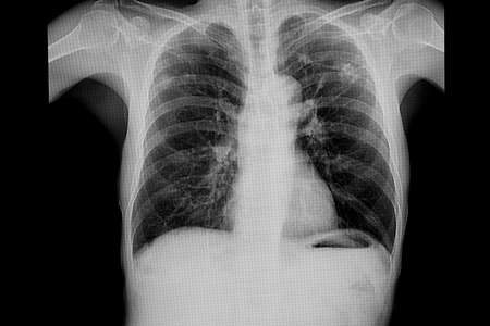Xray film of a patient with pulmonary tuberculosis in both upper lung.の写真素材