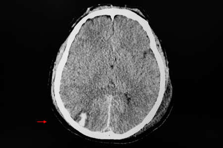 CT brain of a patient with head injury showing hemorrhagic contusion at right occipital lobe.の写真素材