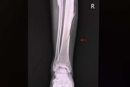 X-ray film of a patient with closed non displaced spiral fracture of right tibia (lower leg bone).
