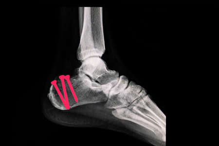 X-ray film of a foot of the patient with fractured calcaneus (heel bone) after surgery. The fixing screws are illustrated in bright red color.の写真素材