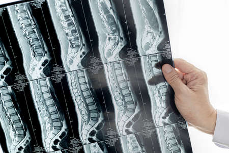 A doctor looking at MRI image of spines.