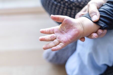Close up of burned hand of small childの写真素材