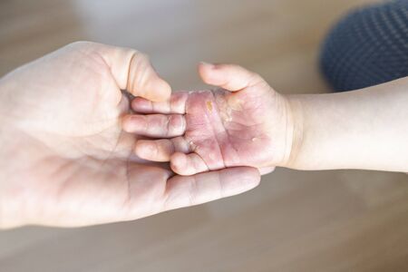 Close up of burned hand of small childの写真素材