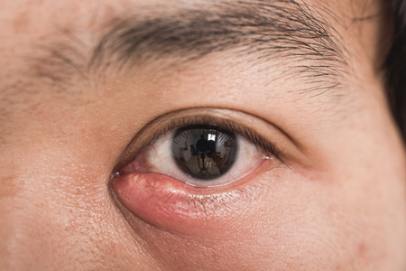 Close up of man eye stye abscess, ophthalmic hordeolum virus diseaseの写真素材