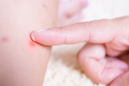 Kid have insect bites, mother applying antiallergic cream children knee on red spot by mosquito biteの写真素材