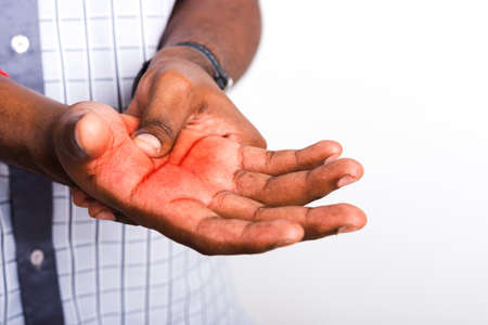 Closeup hand Asian black man holds his palm hand injury, feeling pain, studio shot isolated on white background. Health care and medical office syndrome conceptの写真素材