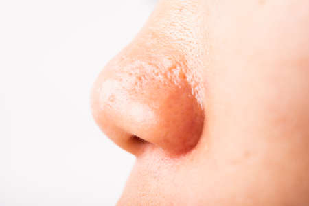 Closeup Asian young woman large pores have freckles cheek oily, acne pimple on nose, studio shot...