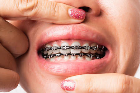 Close up detail macro of young Asian woman smile show mouth with white teeth with black brackets...