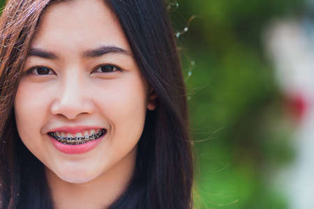 Portrait of Asian teen beautiful young woman smile have dental braces on teeth laughing outdoor, Medicine and dentistry conceptの写真素材