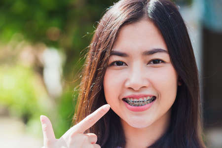 Portrait of Asian teen beautiful young woman smile have dental braces on teeth laughing at outdoor...