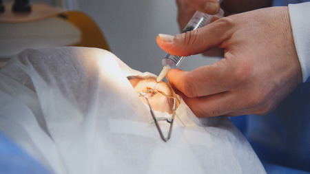 Laser correction for vision - ophthalmology surgery, doctor swab rubs the eyeball