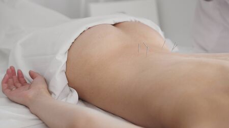 Alternative medicine - acupuncture needles for blonde woman modelの写真素材