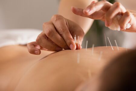 The doctor sticks needles into the girl's body on the acupuncture - close upの写真素材