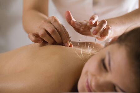 The doctor sticks needles into the womans body on the acupuncture - close upの写真素材