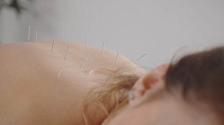 Tibetian medicine - acupuncture - doctor sticks needles, close upの写真素材