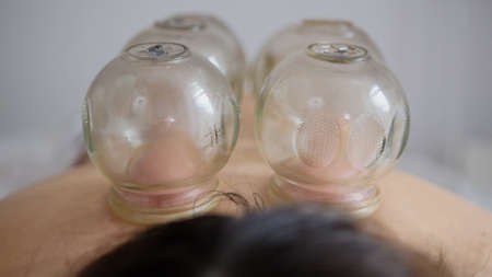 Tibetan medicine - a lot of glass cup on the back of a woman, slider shotの写真素材