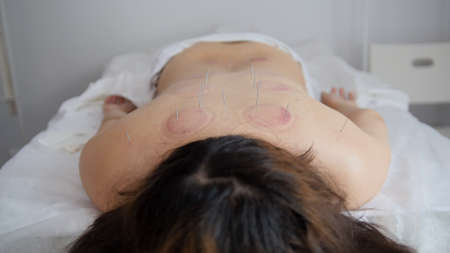 Tibetan medicine - back of a woman after use medical glass procedureの写真素材