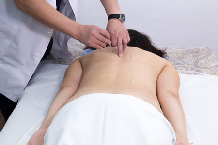 A woman taking acupuncture treatment. Inserting needles in the back. Back viewの写真素材