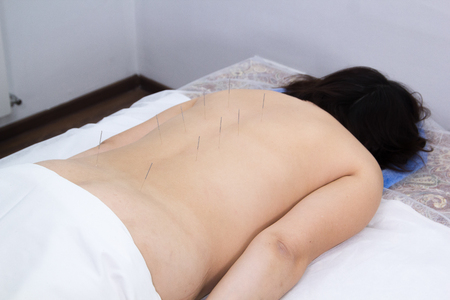 A woman taking acupuncture treatment. Needles in the back. Mid shotの写真素材
