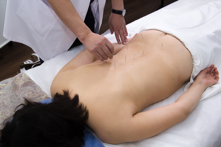 A woman taking acupuncture treatment in the clinic. Inserting needles in the back. Back view. Mid shotの写真素材