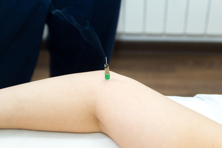 A woman taking a treatment of alternative medicine. Moxo therapy procedure. Handsの写真素材