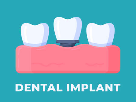 Vector illustration of gum disease isolated on a blue background. Stages of periodontal disease from healthy gums. Modern dentistry.のイラスト素材