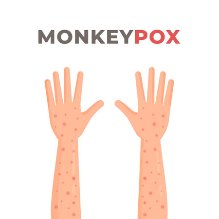 Symptoms of monkeypox. Vector illustration of rash on hands. Monkeypox epidemic in Africa and Spain. infection.のイラスト素材