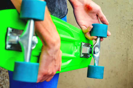 Closeup of a young caucasian man with a skate board in his hand. Injuries in extreme sports. Traumatic extreme sports conceptの写真素材
