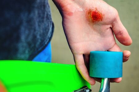 Closeup of a young caucasian man with a skate board in his hand. Injuries in extreme sports. Traumatic extreme sports conceptの写真素材