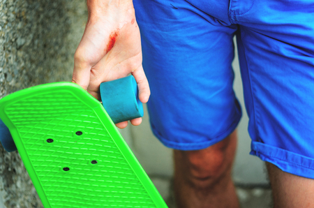 Closeup of a young caucasian man with a skate board in his hand. Injuries in extreme sports. Traumatic extreme sports conceptの写真素材