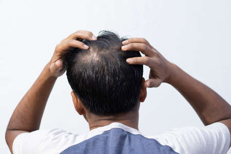 A middle aged Indian man showing his hair fall back facing on white background