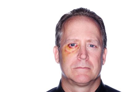 headshot of a man with a bruised eye from an injuryの写真素材