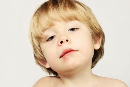 A young boy with an injured lip and a bloody nose