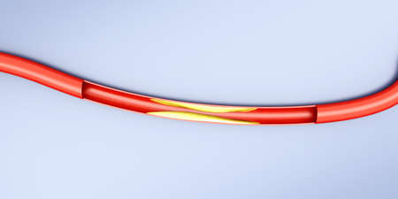 Arteriosclerosis  Plaques tightening an artery  3D rendered Illustration   の写真素材