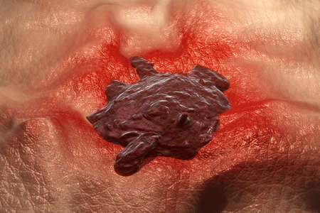 3D illustration of a close-up of skin cancer like the malign melanoma inflaming surrounding tissue.の写真素材