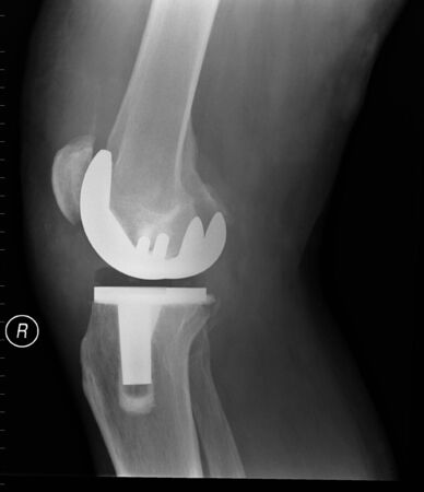 X-Ray of right total knee replacementの写真素材