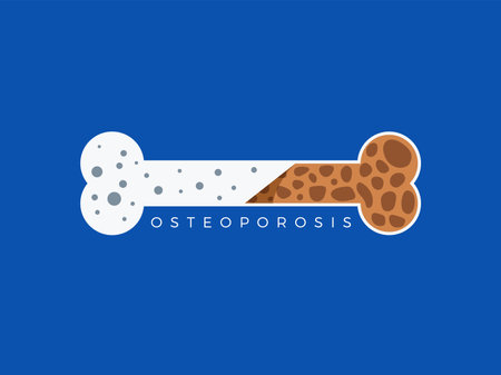 An illustration of Osteoporosis bone. Isolated Vector Illustrationのイラスト素材