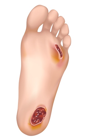 Diabetic foot. Vector illustration.のイラスト素材