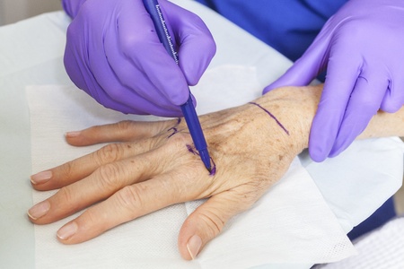 A plastic surgeon using a pen to mark a senior female woman's hand for surgery 