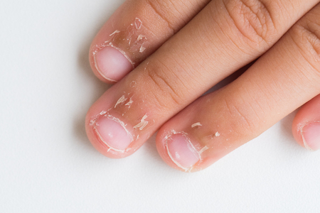 Close up child's fingers with dry skin, Eczema Dermatitis. Medicine and health care concept.の写真素材