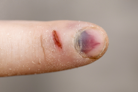 Pain and hematoma after injury. The outcome after the hit. Close up shot of a bruised finger nailの写真素材